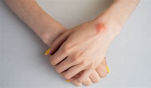 Image result for Cyst On Wrist