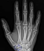 Image result for Capitate Bone Fracture Repair