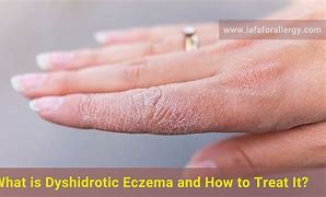 Image result for Best Treatment for Dyshidrotic Eczema