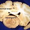 Image result for Meningioma CT Head