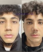 Image result for Columella Septum