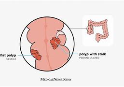 Image result for Sessile Thrombus