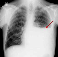 Image result for Pleural Infection