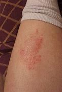 Image result for Thickened Skin On Lower Legs