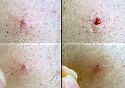 Image result for Ingrown Tools