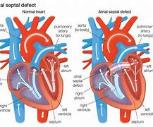 Image result for Atrial Septal Defect Blood Flow