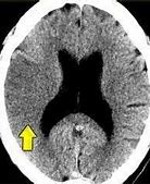 Image result for CT Brain Lentiform Nucleus