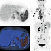 Image result for Hodgkin Lymphoma PET/CT