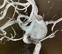 Image result for ICA Aneurysm