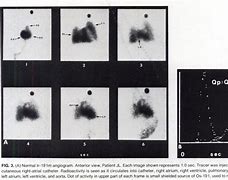 Image result for Ir Angiogram