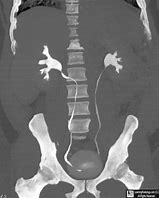 Image result for Retrocaval Surter Radiology