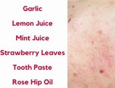 Image result for What Helps with Acne Scars