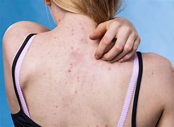 Image result for Itchy Face with Pimples