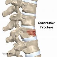 Image result for Compression Fracture Lumbar Surgery