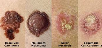 Image result for Skin Cancer Lower Back