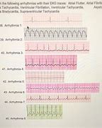 Image result for AFib vs V-fib