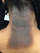 Image result for Eczema On Black Skin with Grey Colour