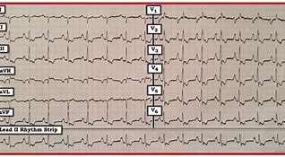 Image result for RVH ECG