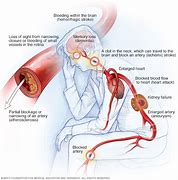 Image result for High Blood Pressure Cardiovascular Disease