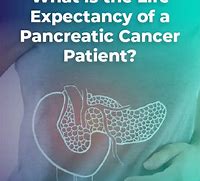 Image result for Pancreatic Cancer Recurrence Life Expectancy