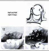 Image result for partial denture clasps materials