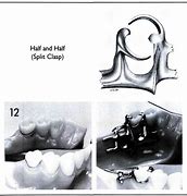 Image result for Partial Denture Clasps