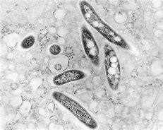 Image result for Mycobacterium Avium Infection