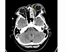 Image result for Subperiosteal Abscess Orbital Cellulitis