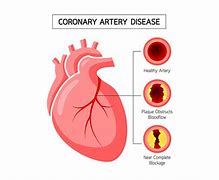 Image result for Coronary Artery Disease