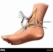 Image result for Medial Malleolus Epiphysis