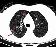 Image result for Multiple Lung Nodules