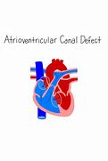 Image result for Atrioventricular Canal Defect Osmosis