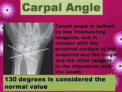 Image result for Carpal Angle