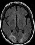 Image result for Toxic Encephalopathy