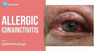 Image result for Allergic Conjunctivitis Treatment