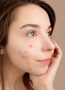 Image result for Pimple Face Wallpaper