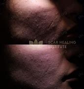 Image result for Atrophic Scar Treatment