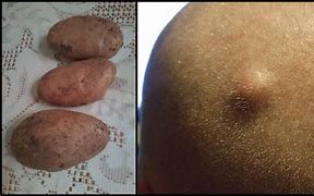 Image result for Cyst White Paste