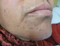 Image result for Flat Warts Under Eyes