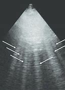 Image result for Lung Ultrasound B Lines Pulmonary Edema