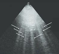 Image result for B Lines Chest Ultrasound