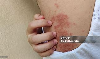 Image result for Pustules Back