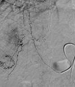 Image result for Tace Ablation