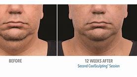 Image result for CoolSculpting Chin Before and After