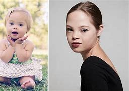 Image result for Down Syndrome Baby Pictures