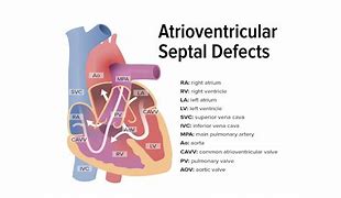 Image result for Atrioventricular Septum