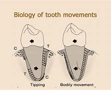 Image result for Propel Tooth Movement