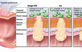 Image result for Adenocarcinoma Rectal Cancer