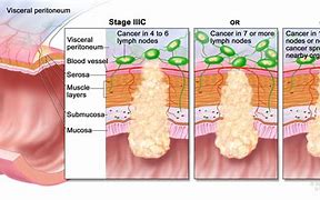 Image result for Cancer De Colon Tac