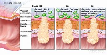 Image result for Rectal Cancer Resection